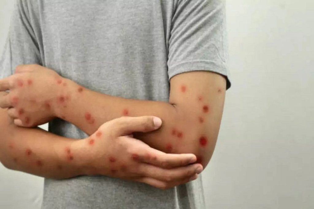 Νόσος Mpox : Οδηγίες για τους ταξιδιώτες